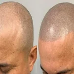 Scalp Micropigmentation Aftercare Instructions for Optimal Healing