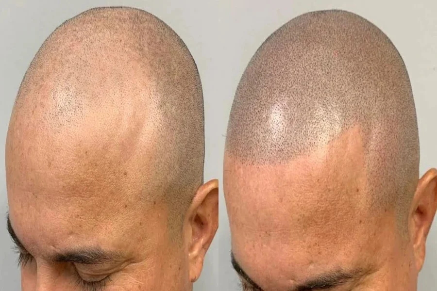 Scalp Micropigmentation Aftercare Instructions for Optimal Healing
