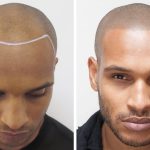 hair transplants