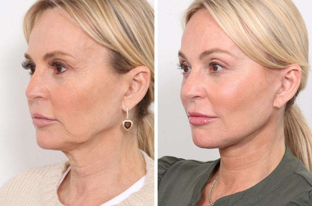 Which Facelift Procedures Offer the Most Natural Results