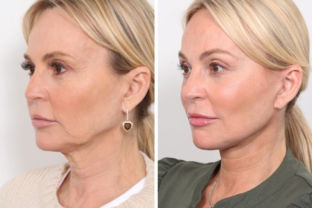 Which Facelift Procedures Offer the Most Natural Results