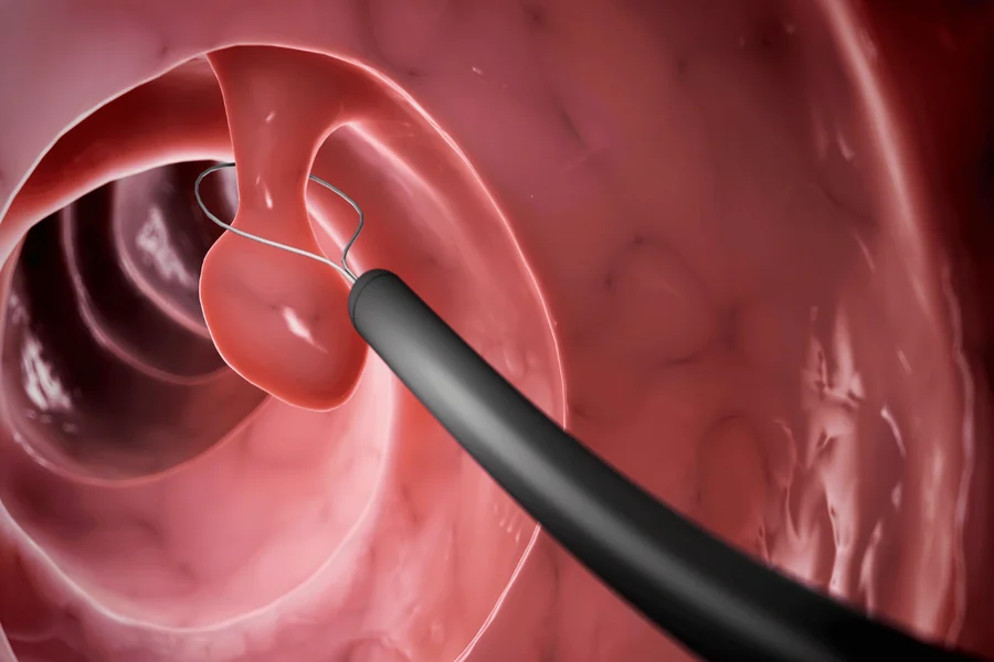 Colorectal Cancer Singapore